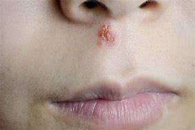 Image result for Cold Sore Marks