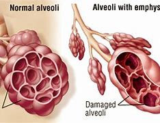 Image result for Emphysema