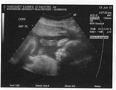 Image result for Male Baby Ultrasound