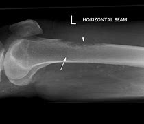 Image result for Sclerosis Bone Metastases X-ray