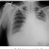 Image result for Pleural Biopsy