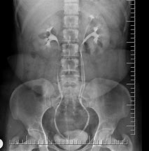 Image result for Right Ureter X-ray