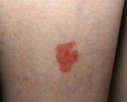 Image result for Basal Cell Carcinoma Cancer Symptoms