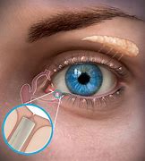 Image result for Punctal Occlusion