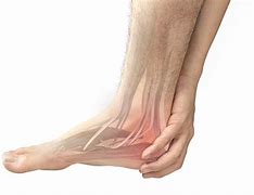 Image result for Plantar Fascia Rupture