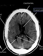 Image result for Capitate CT Scan