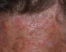 Image result for Basal Cell Carcinoma Lesions