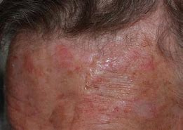 Image result for Basal Cell Carcinoma Cancer Symptoms