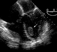 Image result for What Is a Thrombus