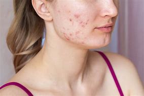 Image result for Pimple Face HD Images