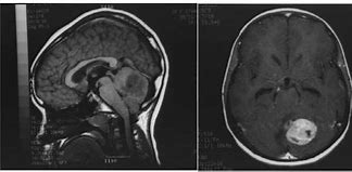 Image result for Medulloblastoma in Child