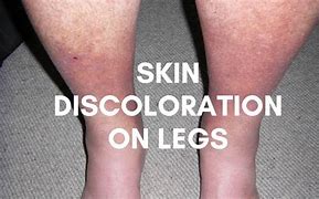 Image result for Skin Darkening Legs