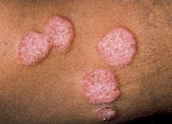 Image result for Raised Circular Lesion On Skin