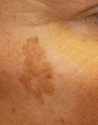 Image result for Black Spots On Skin Means