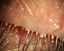 Image result for Eyelash Mites Symptoms