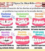 Image result for Tipos De Maloclusion