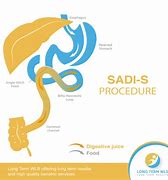 Image result for Sadi S Surgery