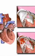 Image result for Acute Endocarditis