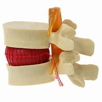 Image result for Lumbar Spine Herniation