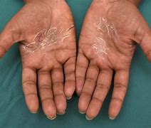 Image result for Eczema On Hands