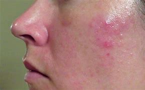 Image result for Deep Acne Cyst