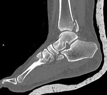 Image result for Posterior Malleolus Fracture Treatment