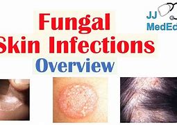 Image result for Heat Rash Fungal Infection