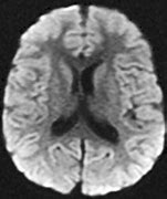 Image result for Diffusion MRI