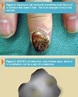 Image result for Skin Cancer On Back of Hand