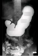 Image result for Stomach in X-ray