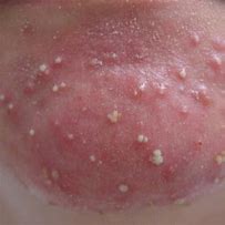 Image result for Large Acne Pustules