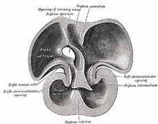 Image result for Interventricular Septum