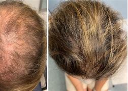 Image result for Low Dose Minoxidil for Hair Loss