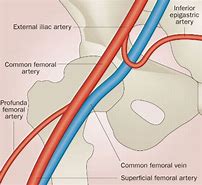 Image result for Femoral Blood Clot