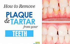 Image result for How to Avoid Plaque On Teeth