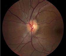 Image result for Papilledema