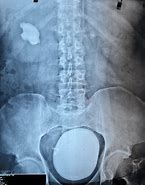 Image result for Right Ureter X-ray