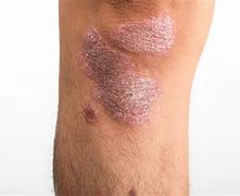 Image result for Clobetasol and Skin Atrophy