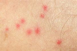 Image result for Treating Insect Bites