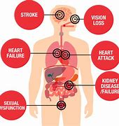 Image result for High Blood Pressure Cardiovascular Disease