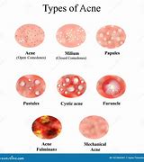 Image result for Pustule Pimple