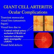 Image result for Giant Cell Temporal Arteritis