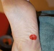 Image result for Plantar Wart Duct Tape