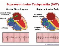 Image result for SVT vs Rapid AFib