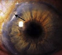 Image result for Corneal Perforation