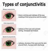 Image result for Allergic Conjunctivitis Treatment