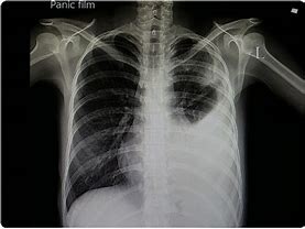 Image result for X-ray Images of Pneumonia