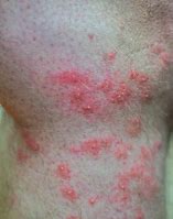 Image result for Ointment for Fire Ant Bites