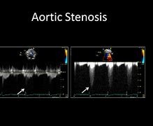 Image result for Aortic Stenosis Doppler