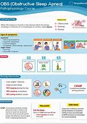 Image result for Osa Sleep Apnea